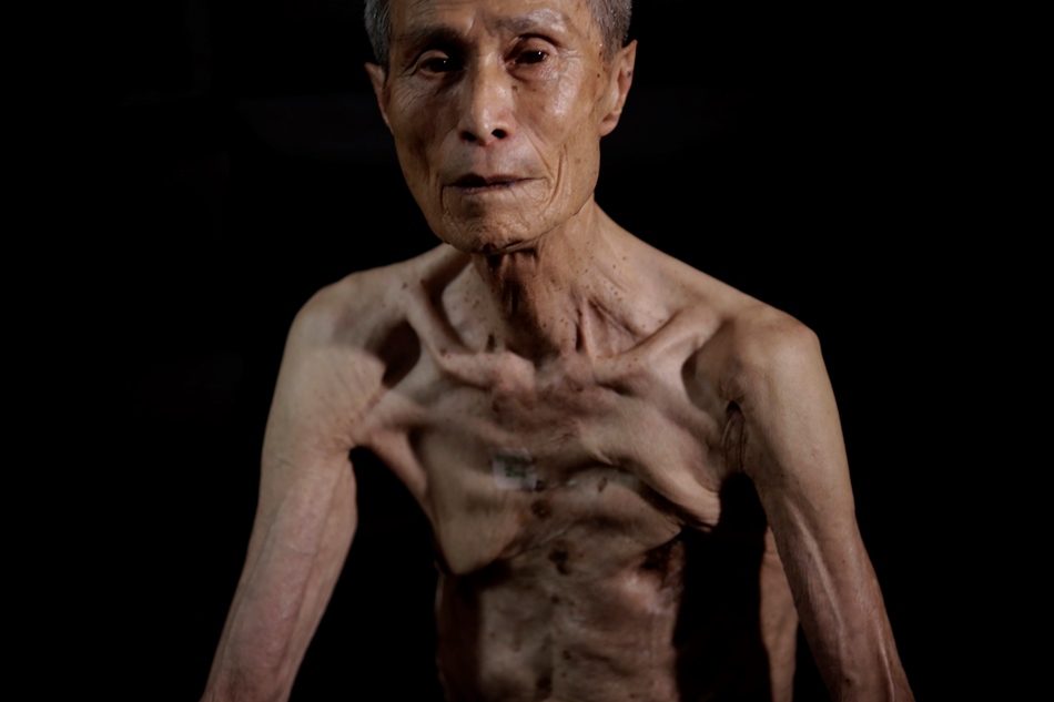 En esta imagen, tomada el 30 de junio de 2015, Sumiteru Taniguchi, de 86 años, un sobreviviente de la bomba atómica de 1945 sobre Nagasaki, posa para una foto durante una entrevista en su oficina en Nagasaki, en el sur de Japón. Durante 70 años, Taniguchi, presidente del Consejo de Sobrevivientes de la Bomba Atómica de Nagasaki, ha vivido una red de heridas que cubren la mayor parte de su espalda mientras los restos de tres costillas medio podridas ejercen una presión constante contra sus pulmones, lo que le dificulta la respiración. (Foto AP/Eugene Hoshiko)