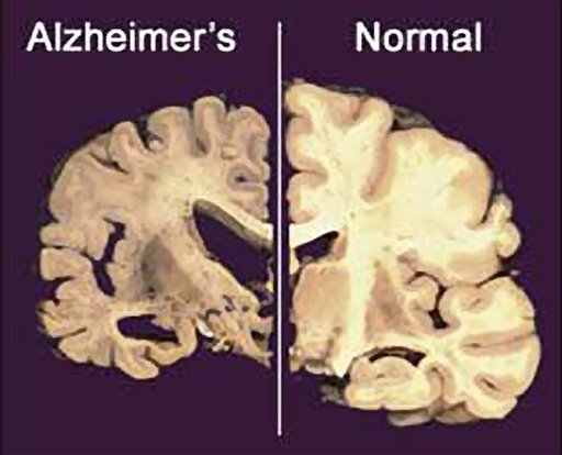 Síndrome de Down y Alzheimer: ¿Cómo se relacionan?