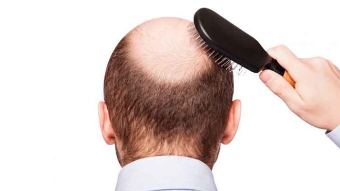 alopecia