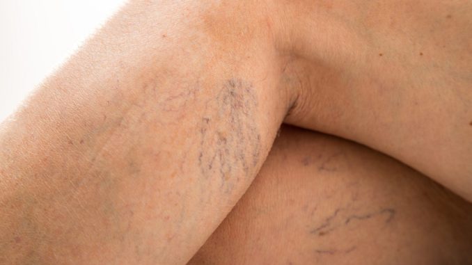 Varices