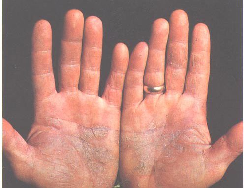 psoriasis