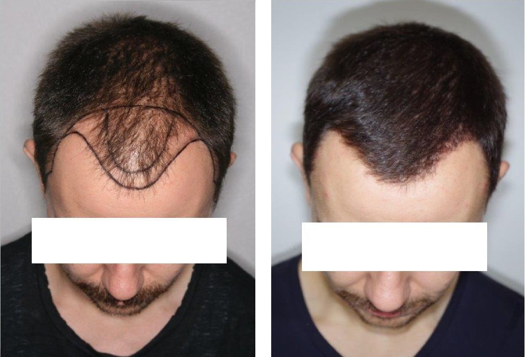 После голова три. Трансплантация волос fue. Пересадка волос бесшовным методом.