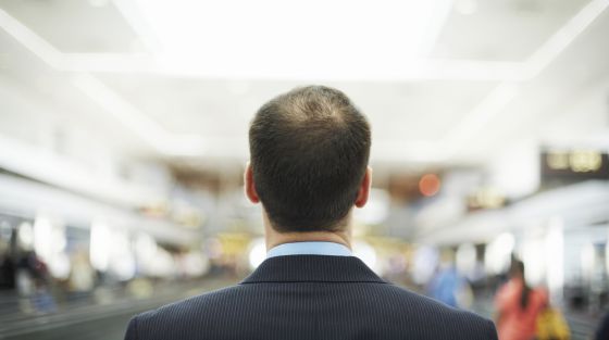 alopecia