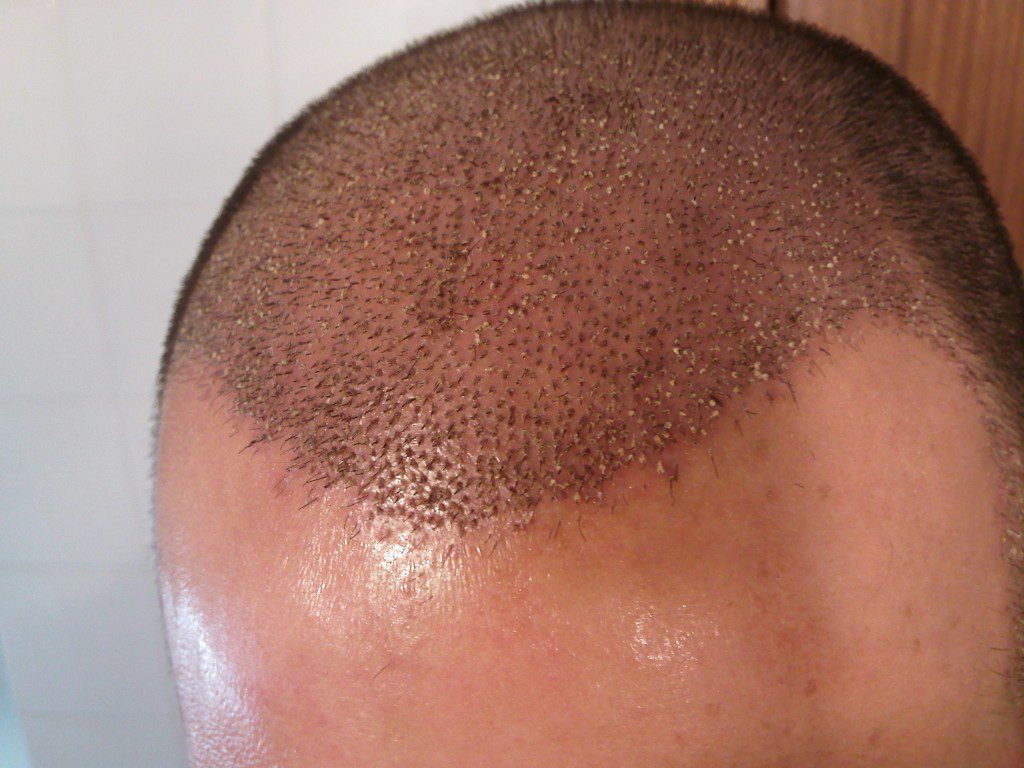 ¿Cuánto tiempo tarda en verse los resultados de un implante de pelo