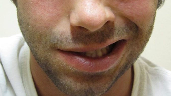 paralisis facial