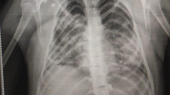 covid-pulmones