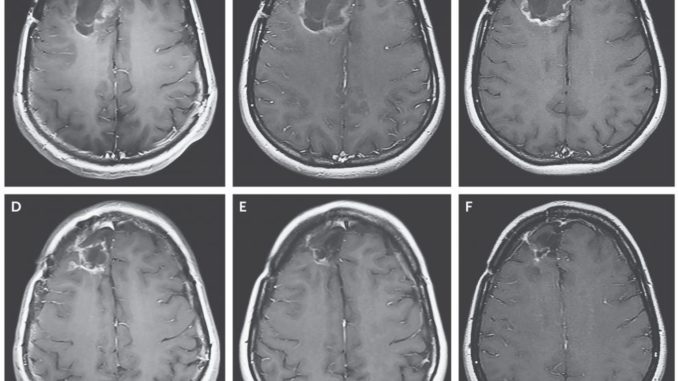 glioblastoma