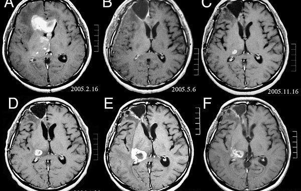 Anaplastic_astrocytoma
