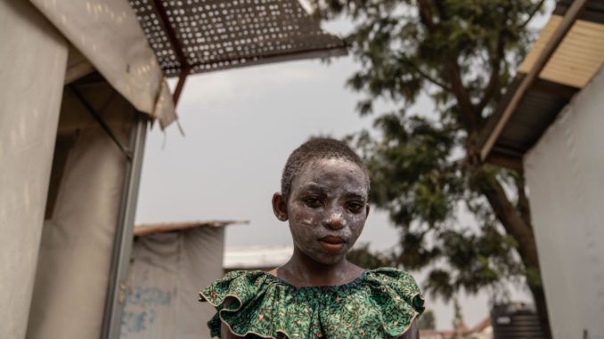 Pacientes con mpox en el Congo
