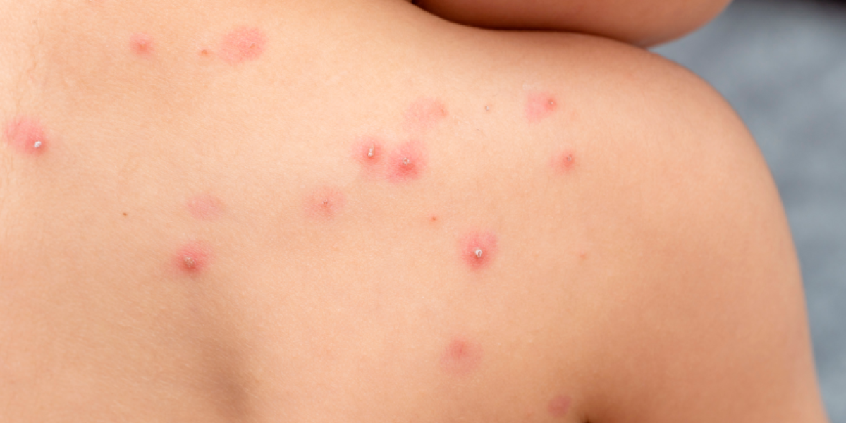 Ecuador detecta primer caso de la variante clado Ib de la mpox